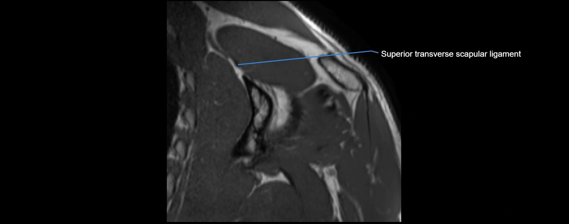 shoulder ligments coronal  cross sectional anatomy 3T MRI AI enhanced radiology image -img-00001-00037.webp